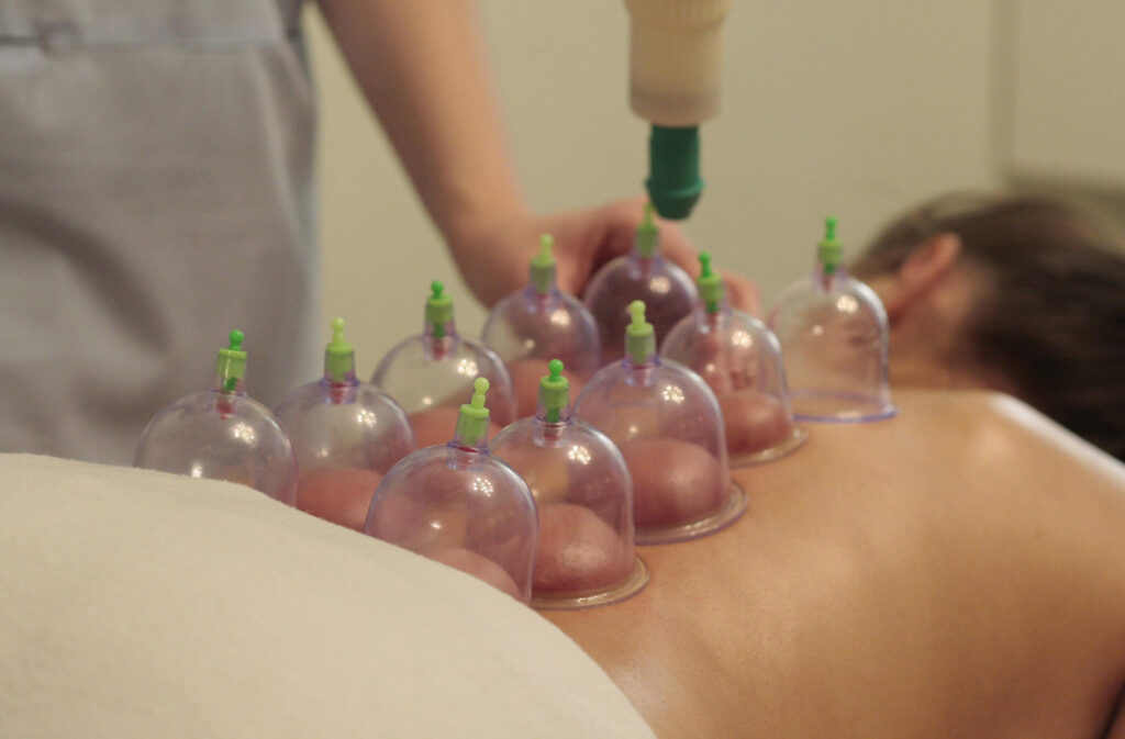 Cupping at Touch Tuina