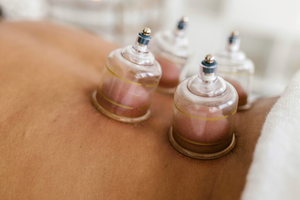 What is Cupping Therapy?