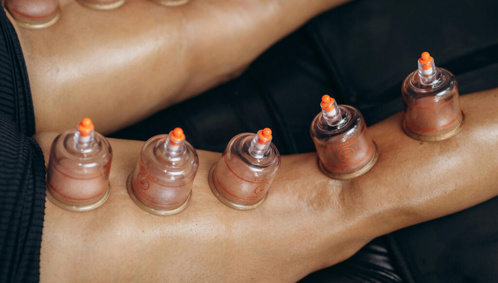 What is Cupping Therapy?