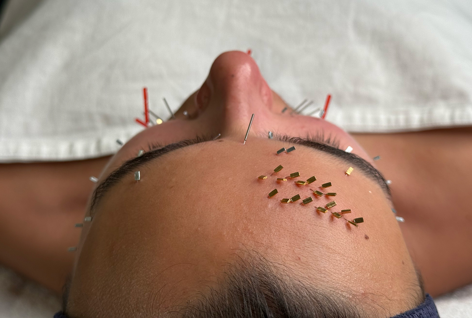 Acupuncture Facial Rejuvenation available at Touch Tuina