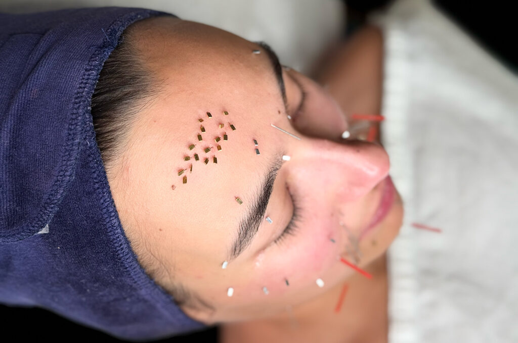 Acupuncture Facial Rejuvenation is available at Touch Tuina